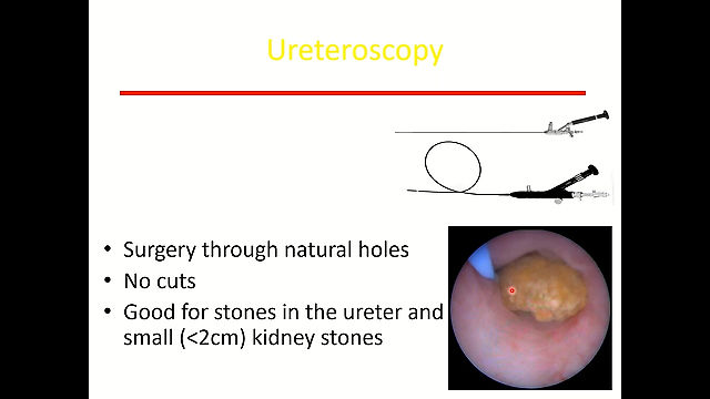 Kidney and bladder stones. Zeph Okeke, MD